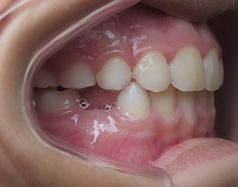 Invisalign First