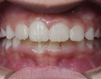 Invisalign First