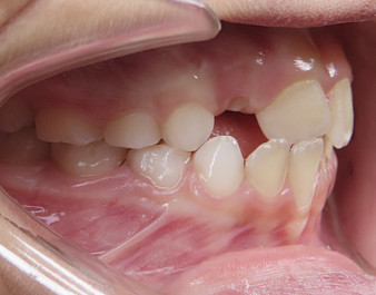 Invisalign First
