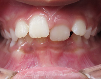 Invisalign First