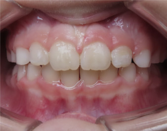 Invisalign First