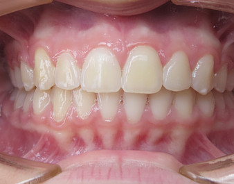 Invisalign Teen