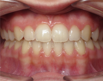 Invisalign Teen