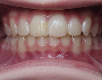 Invisalign Teen