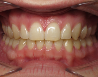 Adult Invisalign