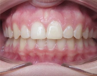 Invisalign Teen