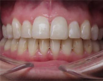 Adult Invisalign