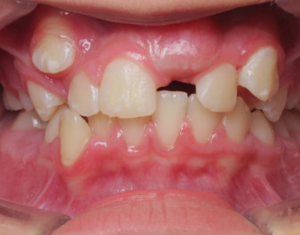 Invisalign Teen