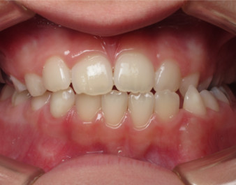 Invisalign Teen