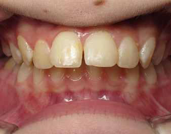 Invisalign Teen