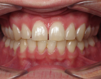Adult Invisalign