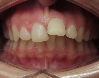 Invisalign Teen