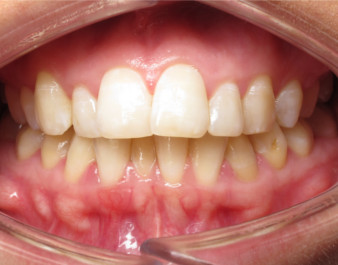 Adult Invisalign