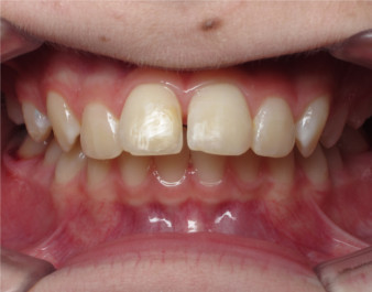 Invisalign Teen