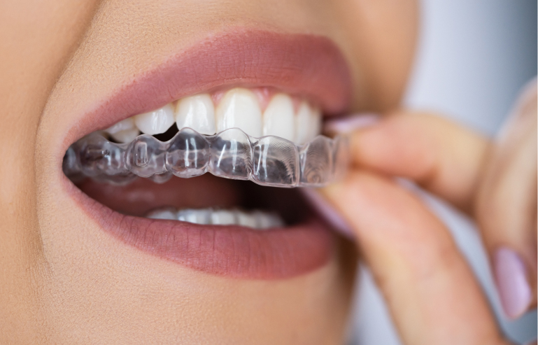 Closeup Of A Woman With Lipstick Insearting Clear Aligners